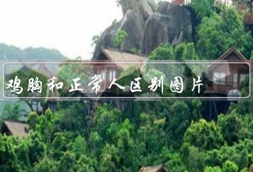 鸡胸和正常人区别图片，胸骨前凸是缺钙导致的小儿佝偻病
