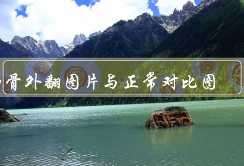肋骨外翻图片与正常对比图