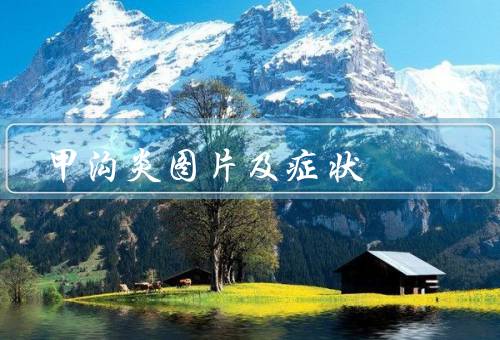 甲沟炎图片及症状